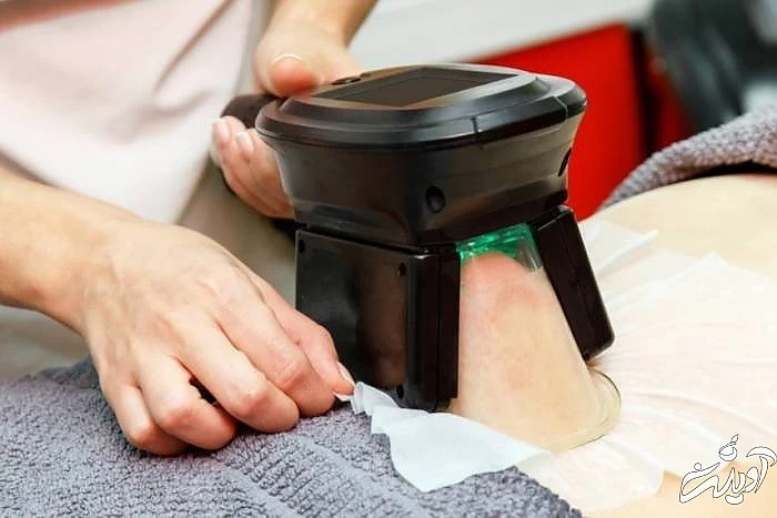 لاغری با کول اسکالپتینگ چگونه است؟ کول اسکالپتینگ